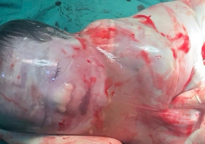 Kỳ diệu bé trai sinh ra trong "bọc điều" ở Hà Nội, chỉ xuất hiện 1/80.000 ca