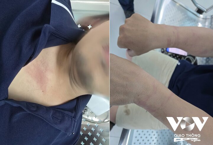 Không chỉ bị còng tay, PV cho biết bản thân còn bị đạp vào vùng hông bên phải.