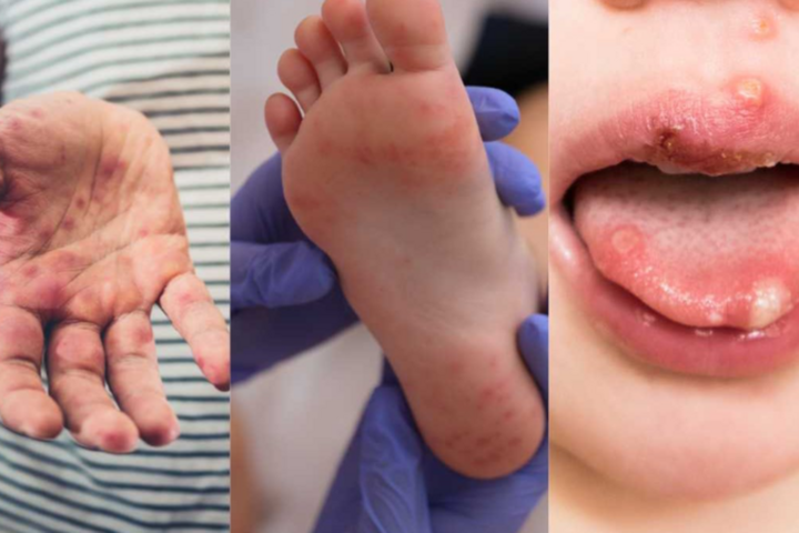 Bệnh tay chân miệng ở trẻ em: Dấu hiệu, nguyên nhân và cách điều trị