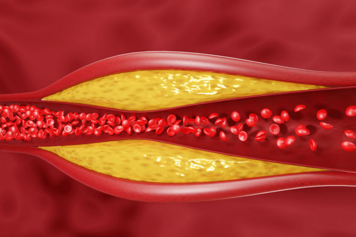 Cách kiểm soát cholesterol ở mức an toàn nhất