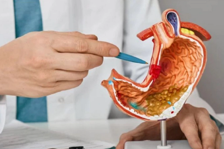 Viêm loét dạ dày: Thông tin bệnh học tổng quan từ A-Z