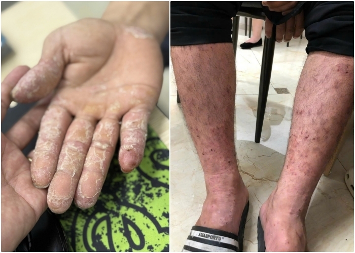 Sau bão, lũ lụt kéo dài tại nhiều địa phương tạo điều kiện cho vi khuẩn, nấm mốc phát triển, làm tăng nguy cơ bùng phát các bệnh ngoài da. (Ảnh: BSCC)