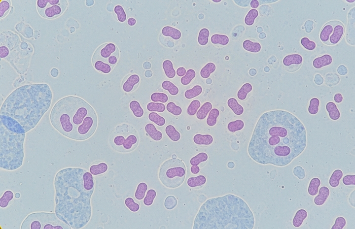 Hà Nội ghi nhận ca mắc não mô cầu là trẻ 11 tuổi, chưa tiêm vaccine