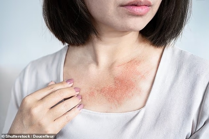Poikiloderma of Civatte là tình trạng do ánh nắng mặt trời gây ra, gây ra các mảng đỏ, đốm nâu, các vùng da sáng màu hơn và các tĩnh mạch mạng nhện ở cổ và vùng da hở.