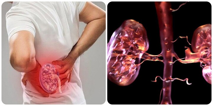 Thận yếu nếu không phát hiện và điều trị sớm sẽ khiến cơ thể tích tụ nhiều chất thải và gây nhiều biến chứng nghiêm trọng đến sức khỏe người bệnh.