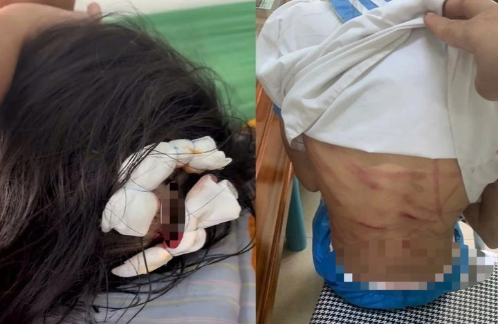 Nữ sinh lớp 5 với nhiều vết thương trên cơ thể nghi bị cha dượng bạo hành. (Quang Đạt)
