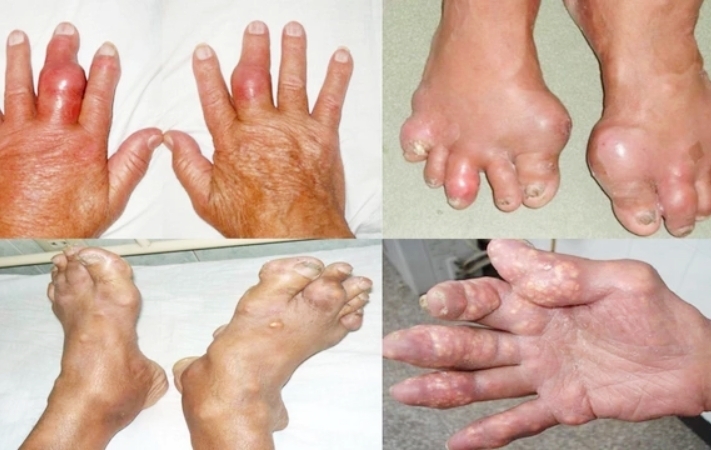 Tổn thương ở người bệnh gout.