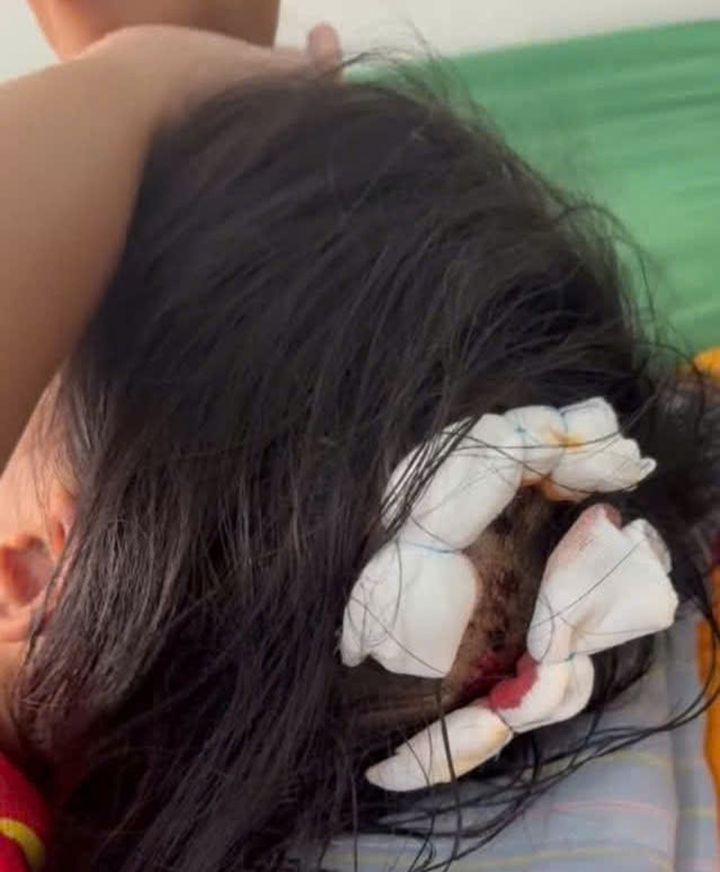 Ngày 19/10 các bác sĩ đã băng vết thương trên đầu cho cháu H.T.N.L.
