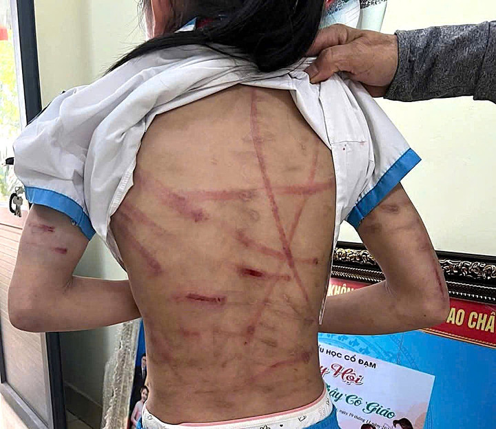 Vết bầm đỏ khắp cơ thể cháu H.T.N.L