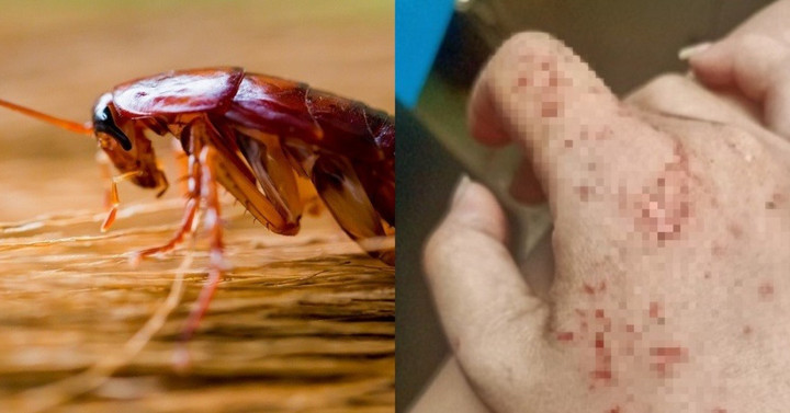 Điều gì xảy ra nếu chúng ta bị gián cắn? (Ảnh: Health)