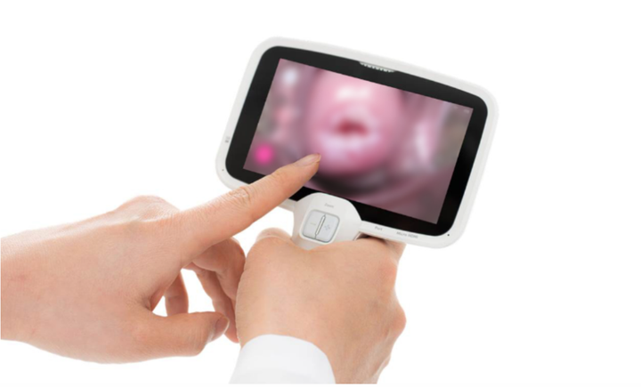 Thiết bị CerviCARE® AI hỗ trợ chẩn đoán sớm ung thư cổ tử cung bằng AI.