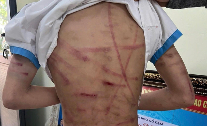 Vết thương trên người bé gái thời điểm bị cha dượng đánh.