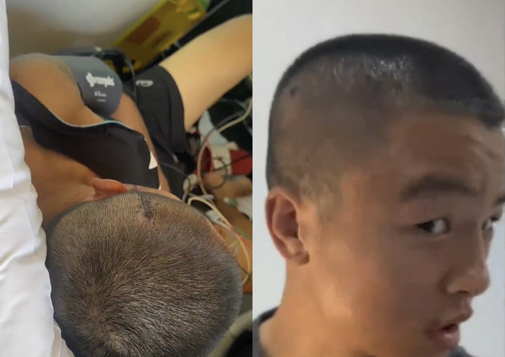 Chu Nhuận Kỳ tiết lộ vết thương ở đầu