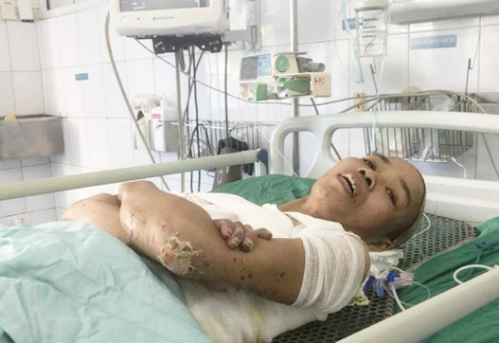 Chị Quy đang điều trị tại Bệnh viện Bỏng Quốc gia.