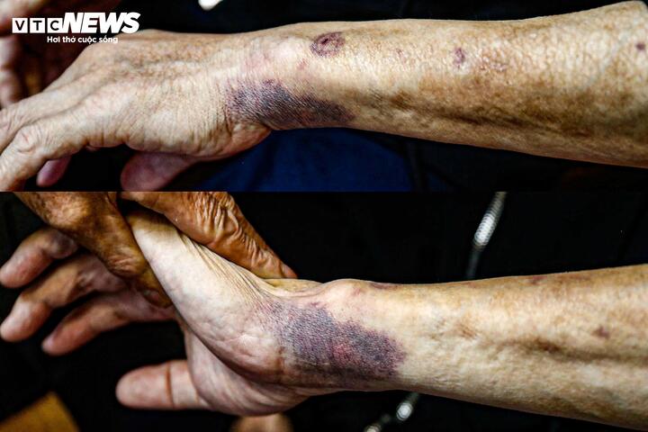 Cổ tay anh Hoàng, bảo vệ tòa nhà bị thâm tím sau khi bị ông C. quật ngã sáng 5/11. (Ảnh: Minh Đức)