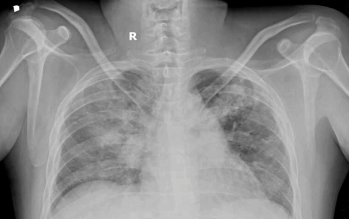 Bệnh nhân nhập viện trong tình trạng phù phổi cấp do quá tải dịch trên nền thận mạn giai đoạn cuối. (Ảnh: BVCC)