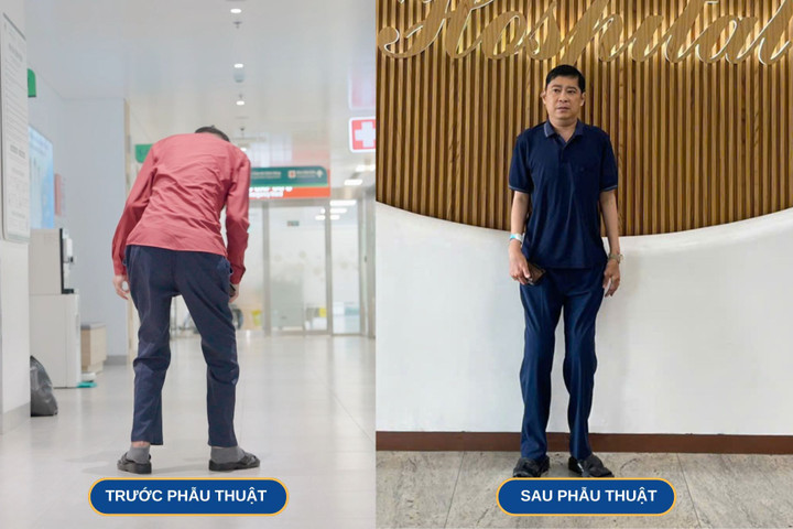 Sau phẫu thuật, bệnh nhân vận động, đi lại bình thường.