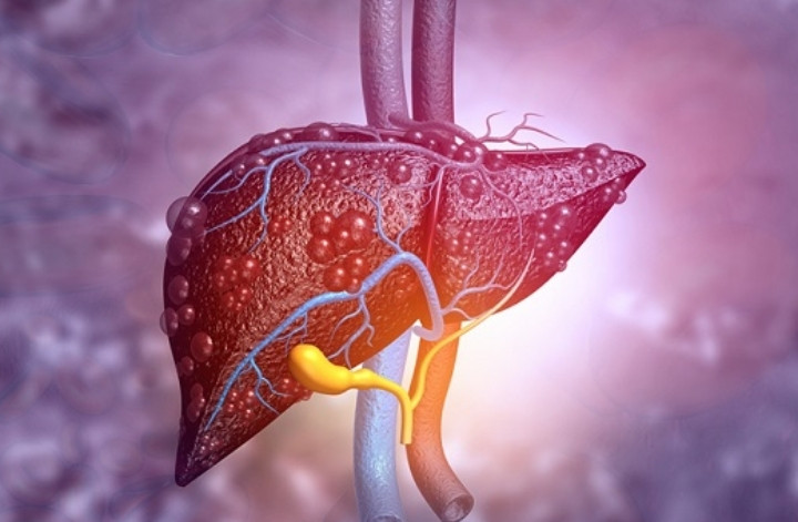 80% trường hợp xơ gan chuyển thành ung thư gan.