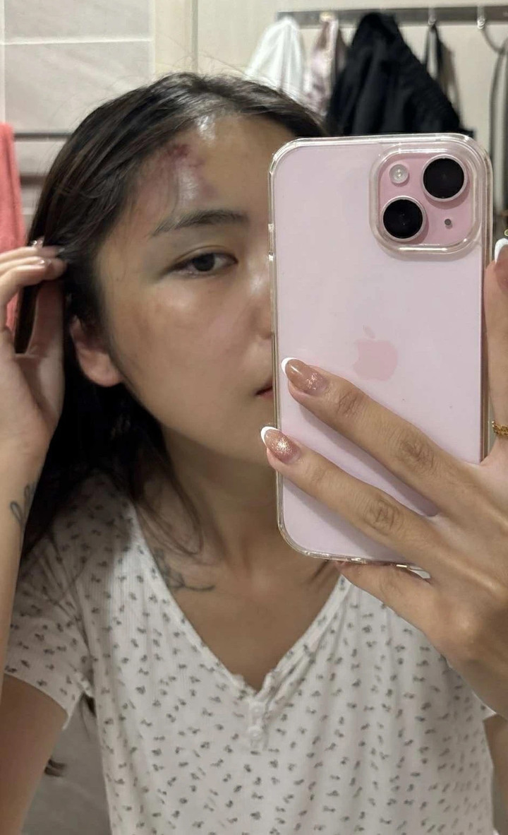 Chấn thương của chị Trang sau vụ hành hung.