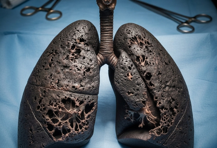 Phổi tổn thương do khói thuốc. (Ảnh minh hoạ)