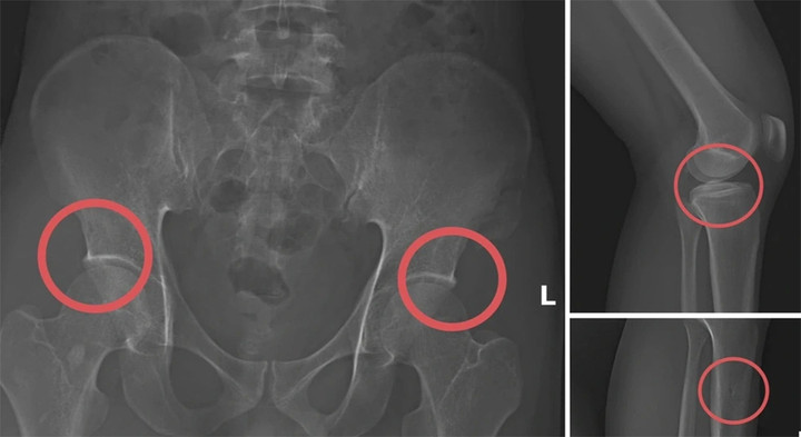 Một số tổn thương xương được Tạ Minh Châu tạo ra nhằm trục lợi bảo hiểm nhân thọ