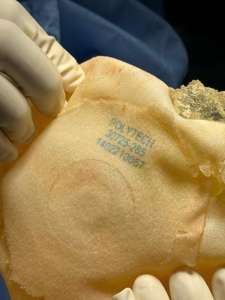 Ưu điểm tháo túi ngực và thay túi ngực, mê mask thanh quản - 3