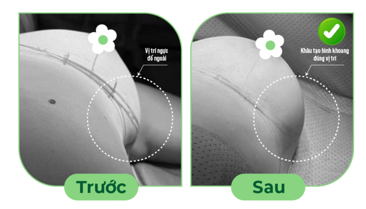 Ưu điểm tháo túi ngực và thay túi ngực, mê mask thanh quản - 1