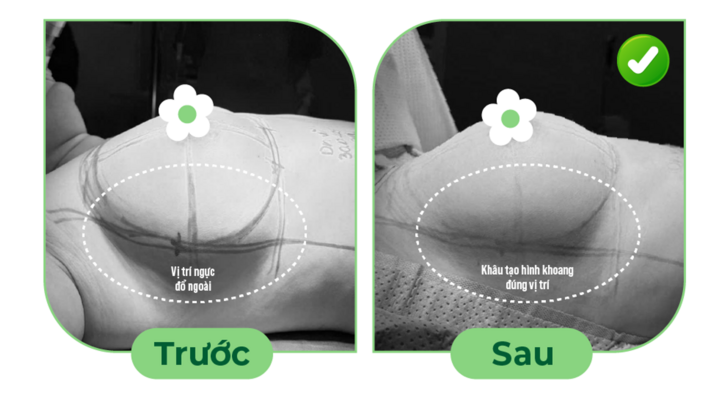 Ưu điểm tháo túi ngực và thay túi ngực, mê mask thanh quản - 2