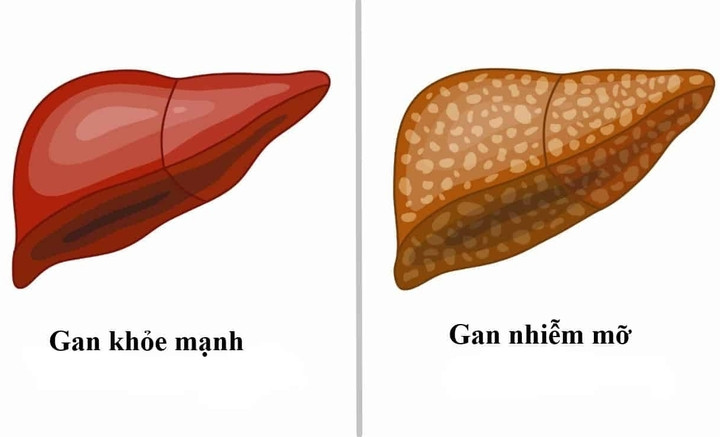 Hình ảnh mô phỏng gan khoẻ mạnh và gan nhiễm mỡ. (Ảnh minh hoạ)