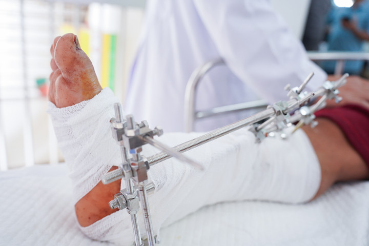 Bệnh viện Chợ Rẫy liên tục tiếp nhận các trường hợp bị đứt lìa chi do tai nạn lao động. (Ảnh: BVCC)