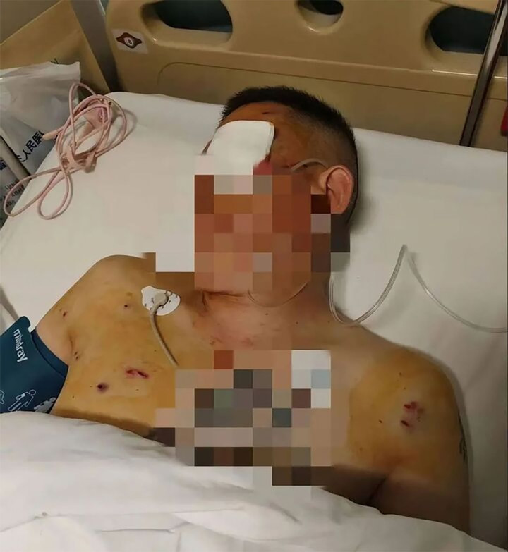 Sau khi rút 1,7 triệu nhân dân tệ, ông Ni bị tên cướp tấn công gây thương tích nặng gay tại lối vào ngân hàng. (Ảnh: Sohu)