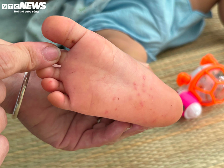 Sở Y tế TP.HCM khuyến cáo sự xuất hiện trở lại của tác nhân EV71, nguy cơ bùng phát dịch tay chân miệng.