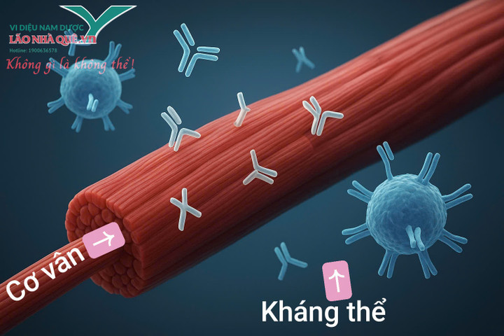 Bệnh kháng thể tự miễn tiêu cơ vân (Hình ảnh minh họa kháng thể nhầm lẫn và tấn công chính các sợi cơ vân của cơ thể)
