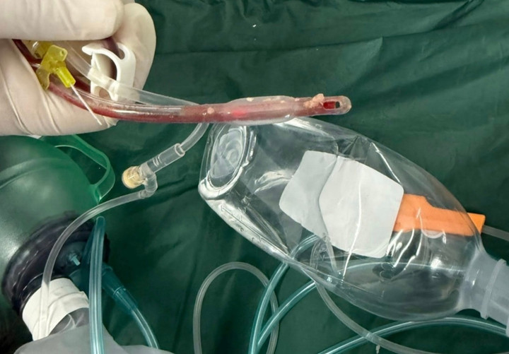 Thức ăn nghẹt dính vào ống nội khí quản của bệnh nhi. (Ảnh: BSCC)