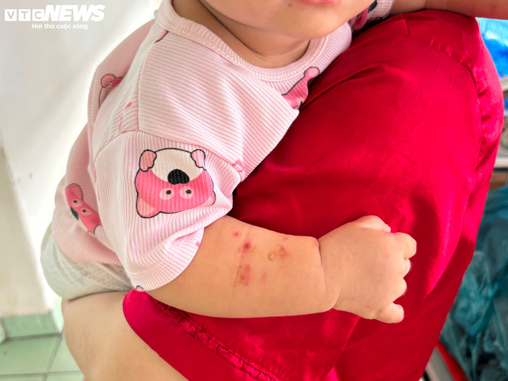 Người nhà không tự ý bôi thuốc màu lên các bóng nước vì sẽ gây khó khăn cho việc chẩn đoán.