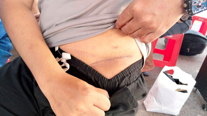 Vết sẹo dài bên mạng sườn em T.M.L.