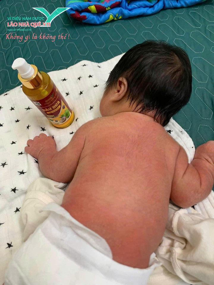 Dầu dừa dùng mát xoa dưỡng ẩm bảo vệ da cho trẻ nhỏ.