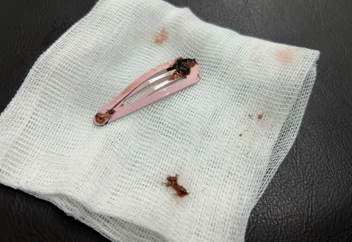 Kẹp tóc dài 7cm được gắp ra ngoài. (Ảnh: BV)