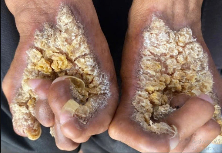 Bàn tay anh Sơn trước khi điều trị. (Ảnh: Bác sĩ cung cấp)