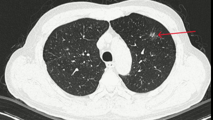 AI được ví như "con mắt thứ ba" phát hiện ung thư.