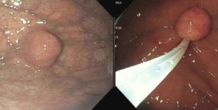 Bất thường tại dạ dày được phát hiện trên hình ảnh nội soi.