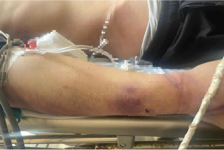 Nhiều vết thương bầm tím trên cơ thể học viên N. (Ảnh: Đ.X)