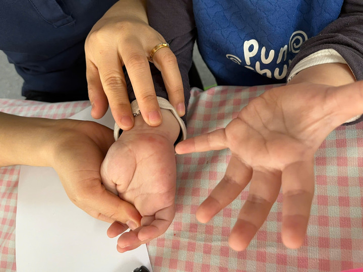 Triệu chứng ban đầu của bệnh thường khá nhẹ và dễ nhầm lẫn với các bệnh thông thường khác.