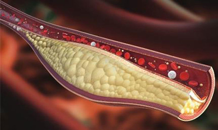 Máu nhiễm mỡ làm tăng nguy cơ mắc các bệnh lý.