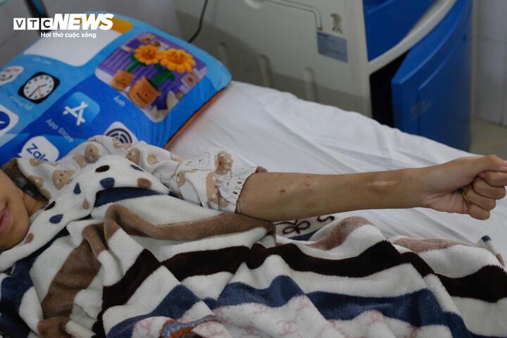 Bàn tay gầy gò của Hương chi chít những vết u hạch, vết sẹo là di chứng của căn bệnh quái ác và những lần lọc máu.