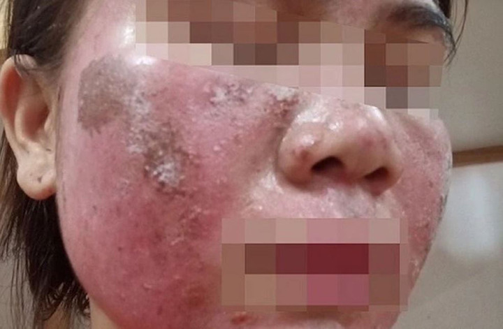 Cảnh báo trào lưu peel da tại nhà làm đẹp cấp tốc đón Tết (Ảnh: BSCC)