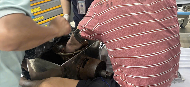 Bàn tay người đàn ông bị kéo vào máy xay thịt. (Ảnh: BVCC)