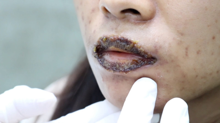 Bệnh nhân nhập viện vì biến chứng sau khi khử thâm môi.