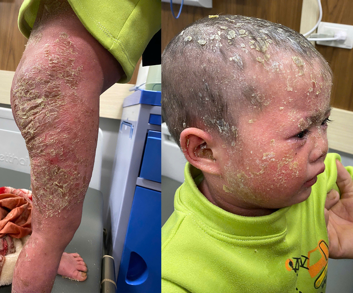 Những mảng da tróc vẩy khiến bé Hiền đau đớn.