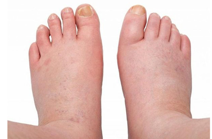 Phù chân là dấu hiệu điển hình của bệnh thận (Ảnh: Pharmacity)